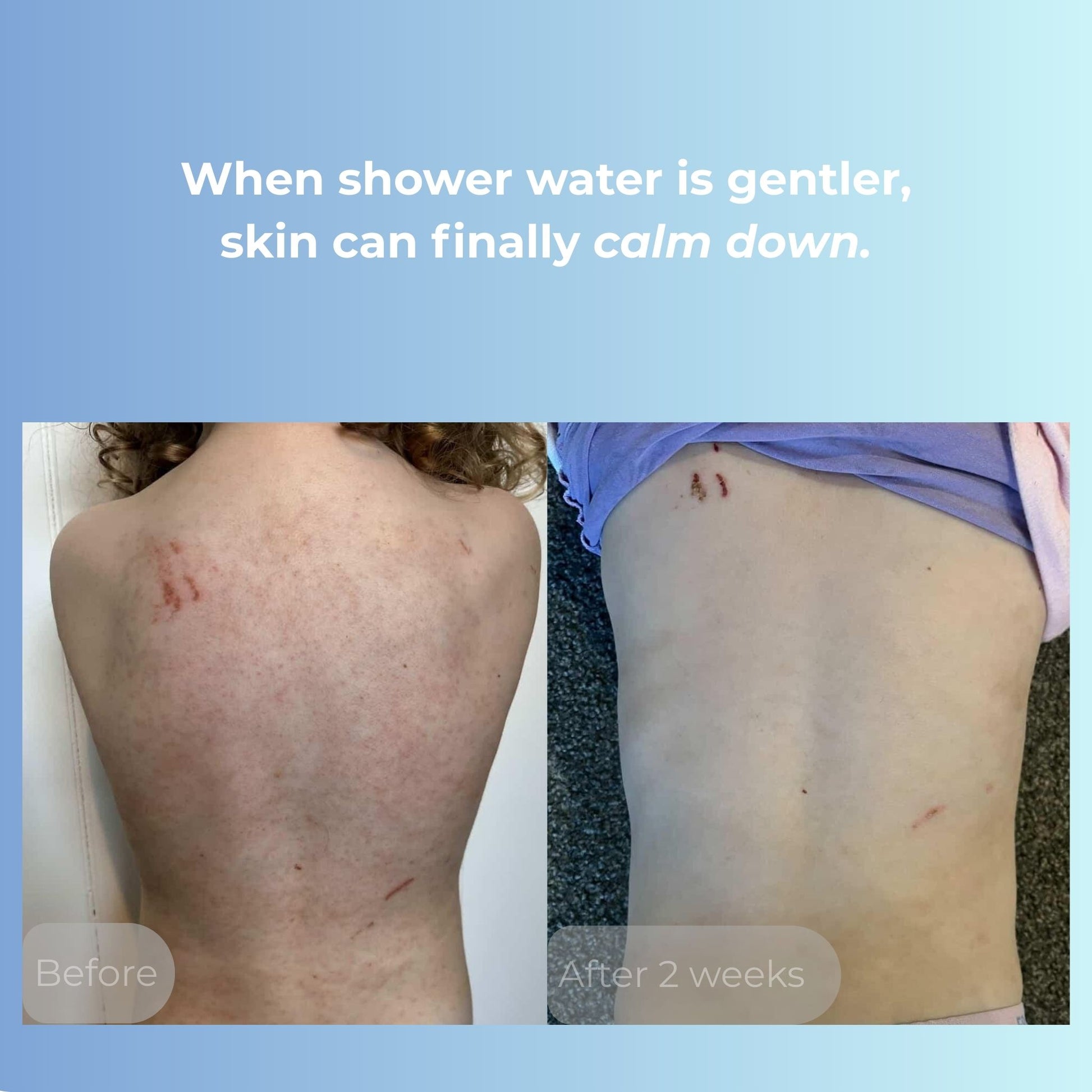Before and after comparison of skin improvement with text on a blue background.